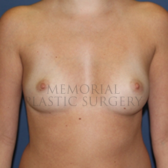 A front view before photo of patient 385 that underwent Breast Augmentation procedures at Memorial Plastic Surgery