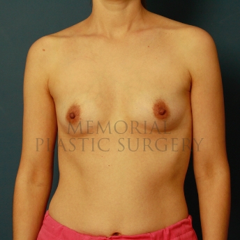 A front view before photo of patient 462 that underwent Breast Augmentation procedures at Memorial Plastic Surgery
