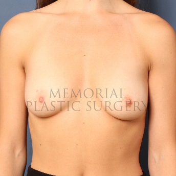 A front view before photo of patient 403 that underwent Breast Augmentation procedures at Memorial Plastic Surgery