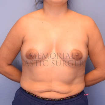 A front view before photo of patient 1257 that underwent Breast Augmentation procedures at Memorial Plastic Surgery