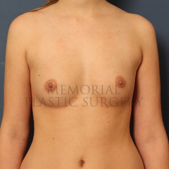 A front view before photo of patient 392 that underwent Breast Augmentation procedures at Memorial Plastic Surgery