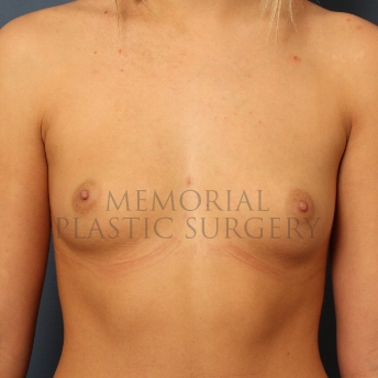 A front view before photo of patient 395 that underwent Breast Augmentation procedures at Memorial Plastic Surgery
