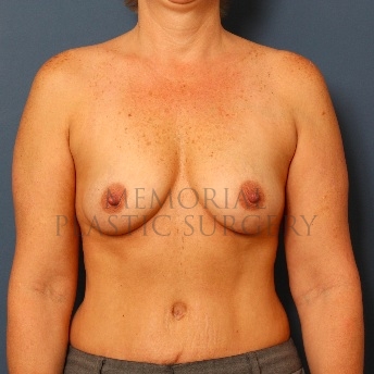 A front view before photo of patient 83 that underwent Breast Augmentation procedures at Memorial Plastic Surgery