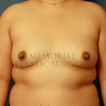 A front view before photo of patient 419 that underwent Breast Augmentation procedures at Memorial Plastic Surgery