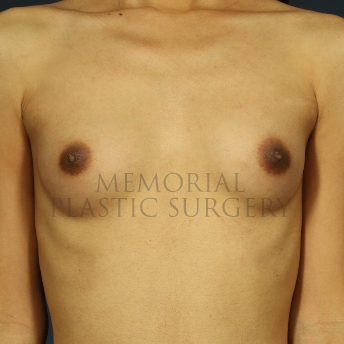 A front view before photo of patient 473 that underwent Breast Augmentation procedures at Memorial Plastic Surgery