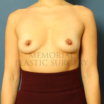 A front view before photo of patient 120 that underwent Breast Augmentation procedures at Memorial Plastic Surgery