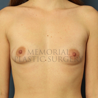 A front view before photo of patient 346 that underwent Breast Augmentation procedures at Memorial Plastic Surgery
