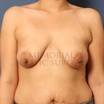 A front view before photo of patient 254 that underwent Breast Augmentation procedures at Memorial Plastic Surgery