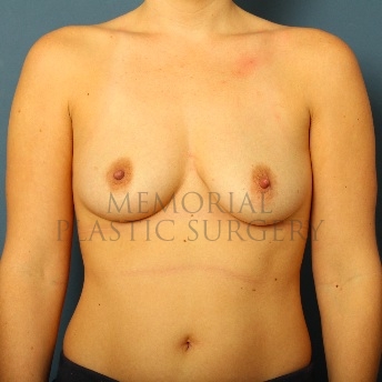 A front view before photo of patient 59 that underwent Breast Augmentation procedures at Memorial Plastic Surgery