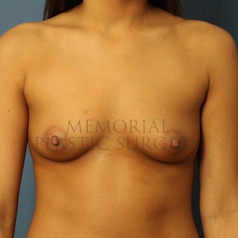 A front view before photo of patient 409 that underwent Breast Augmentation procedures at Memorial Plastic Surgery