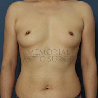 A front view before photo of patient 328 that underwent Breast Augmentation procedures at Memorial Plastic Surgery