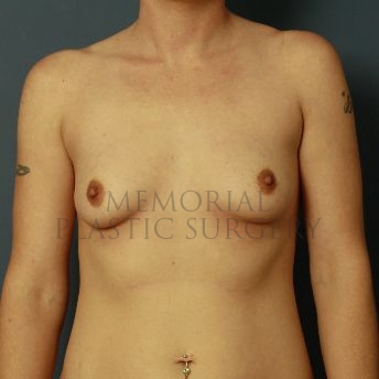 A front view before photo of patient 165 that underwent Breast Augmentation procedures at Memorial Plastic Surgery