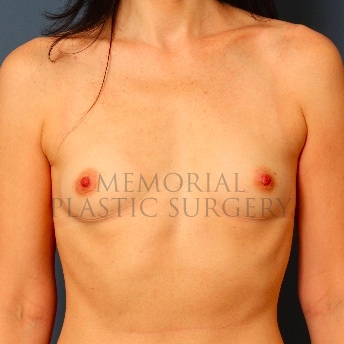 A front view before photo of patient 106 that underwent Breast Augmentation procedures at Memorial Plastic Surgery