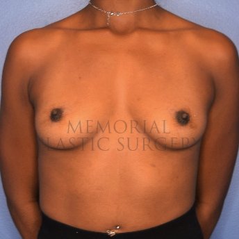 A front view before photo of patient 2412 that underwent Breast Augmentation procedures at Memorial Plastic Surgery
