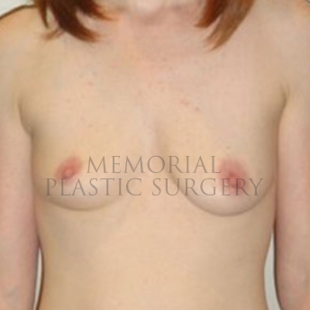 A front view before photo of patient 187 that underwent Breast Augmentation procedures at Memorial Plastic Surgery