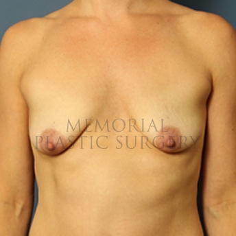 A front view before photo of patient 357 that underwent Breast Augmentation procedures at Memorial Plastic Surgery