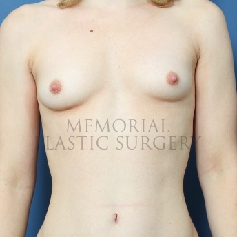 A front view before photo of patient 89 that underwent Breast Augmentation procedures at Memorial Plastic Surgery