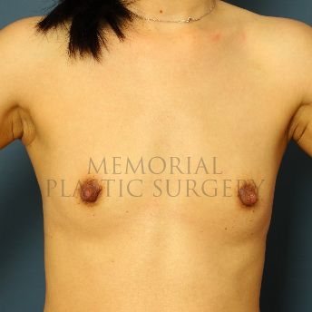 A front view before photo of patient 155 that underwent Breast Augmentation procedures at Memorial Plastic Surgery