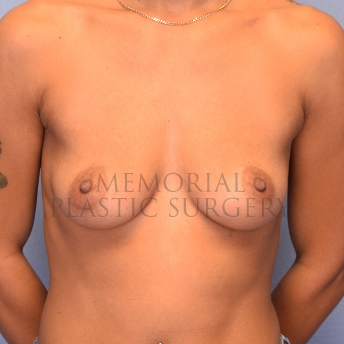 A front view before photo of patient 1072 that underwent Breast Augmentation procedures at Memorial Plastic Surgery