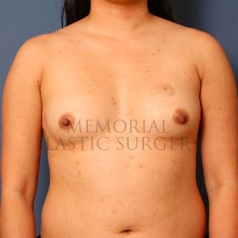 A front view before photo of patient 129 that underwent Breast Augmentation procedures at Memorial Plastic Surgery