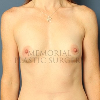 A front view before photo of patient 308 that underwent Breast Augmentation procedures at Memorial Plastic Surgery