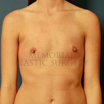 A front view before photo of patient 348 that underwent Breast Augmentation procedures at Memorial Plastic Surgery