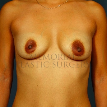 A front view before photo of patient 73 that underwent Breast Augmentation procedures at Memorial Plastic Surgery