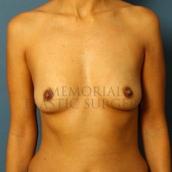 A front view before photo of patient 131 that underwent Breast Augmentation procedures at Memorial Plastic Surgery
