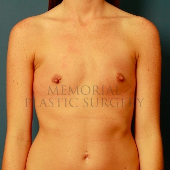 A front view before photo of patient 81 that underwent Breast Augmentation procedures at Memorial Plastic Surgery