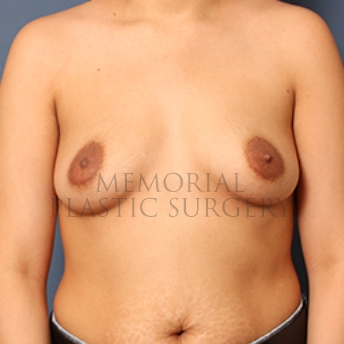 A front view before photo of patient 338 that underwent Breast Augmentation procedures at Memorial Plastic Surgery