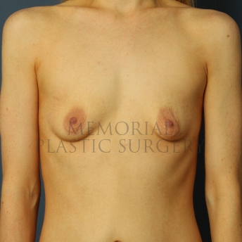 A front view before photo of patient 425 that underwent Breast Augmentation procedures at Memorial Plastic Surgery
