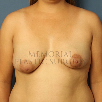 A front view before photo of patient 464 that underwent Breast Augmentation procedures at Memorial Plastic Surgery