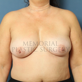 A front view before photo of patient 457 that underwent Breast Augmentation procedures at Memorial Plastic Surgery