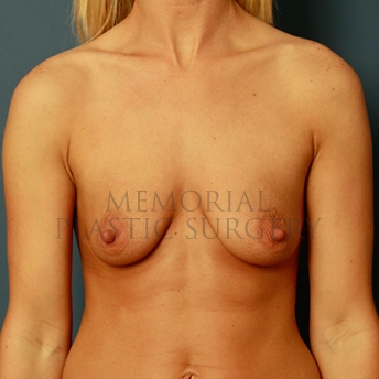 A front view before photo of patient 273 that underwent Breast Augmentation procedures at Memorial Plastic Surgery