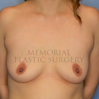 A front view before photo of patient 4106 that underwent Breast Augmentation procedures at Memorial Plastic Surgery