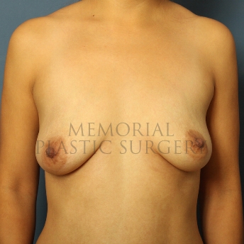 A front view before photo of patient 431 that underwent Breast Augmentation procedures at Memorial Plastic Surgery