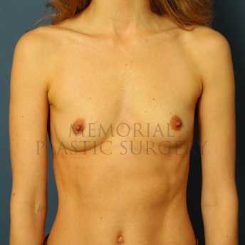 A front view before photo of patient 118 that underwent Breast Augmentation procedures at Memorial Plastic Surgery