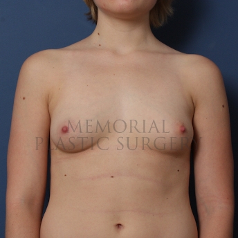A front view before photo of patient 426 that underwent Breast Augmentation procedures at Memorial Plastic Surgery