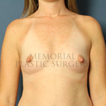 A front view before photo of patient 438 that underwent Breast Augmentation procedures at Memorial Plastic Surgery