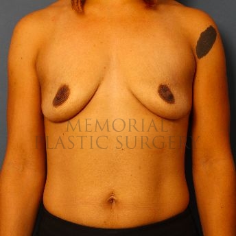 A front view before photo of patient 135 that underwent Breast Augmentation procedures at Memorial Plastic Surgery