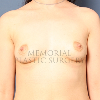 A front view before photo of patient 302 that underwent Breast Augmentation procedures at Memorial Plastic Surgery