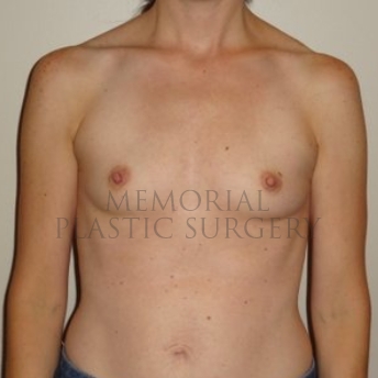 A front view before photo of patient 190 that underwent Breast Augmentation procedures at Memorial Plastic Surgery