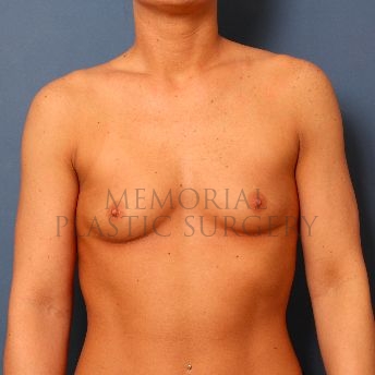 A front view before photo of patient 150 that underwent Breast Augmentation procedures at Memorial Plastic Surgery
