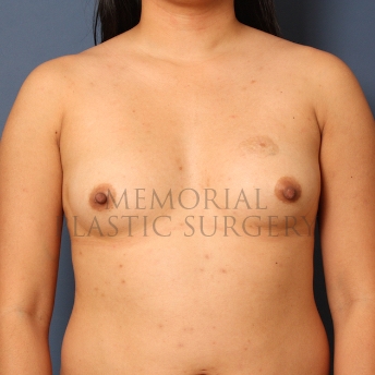 A front view before photo of patient 418 that underwent Breast Augmentation procedures at Memorial Plastic Surgery