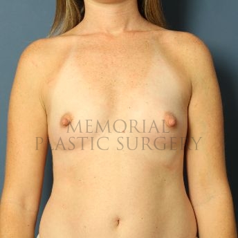 A front view before photo of patient 161 that underwent Breast Augmentation procedures at Memorial Plastic Surgery