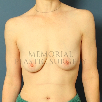A front view before photo of patient 480 that underwent Breast Augmentation procedures at Memorial Plastic Surgery