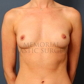A front view before photo of patient 143 that underwent Breast Augmentation procedures at Memorial Plastic Surgery