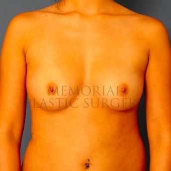 A front view before photo of patient 100 that underwent Breast Augmentation procedures at Memorial Plastic Surgery