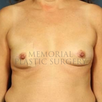A front view before photo of patient 178 that underwent Breast Augmentation procedures at Memorial Plastic Surgery
