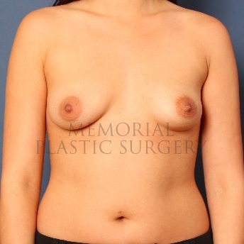 A front view before photo of patient 98 that underwent Breast Augmentation procedures at Memorial Plastic Surgery
